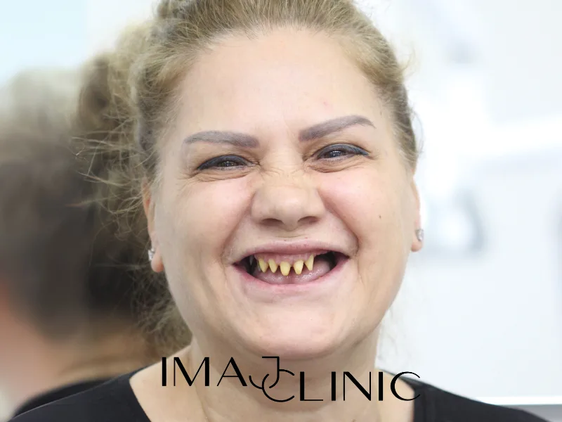 Tedavi öncesi vaka 18