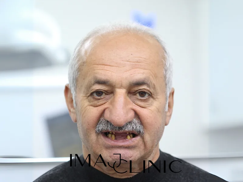Tedavi öncesi vaka 10